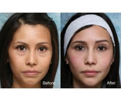Eyebag removal surgery from BUEC Singapore